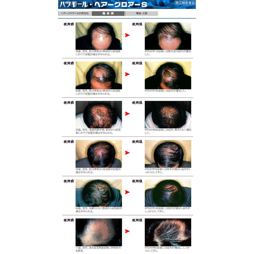 Hatsumoru Hair Grower S 170ml